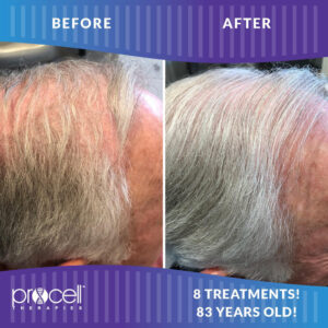Procell Therapies Before & After Images of 83 year old male