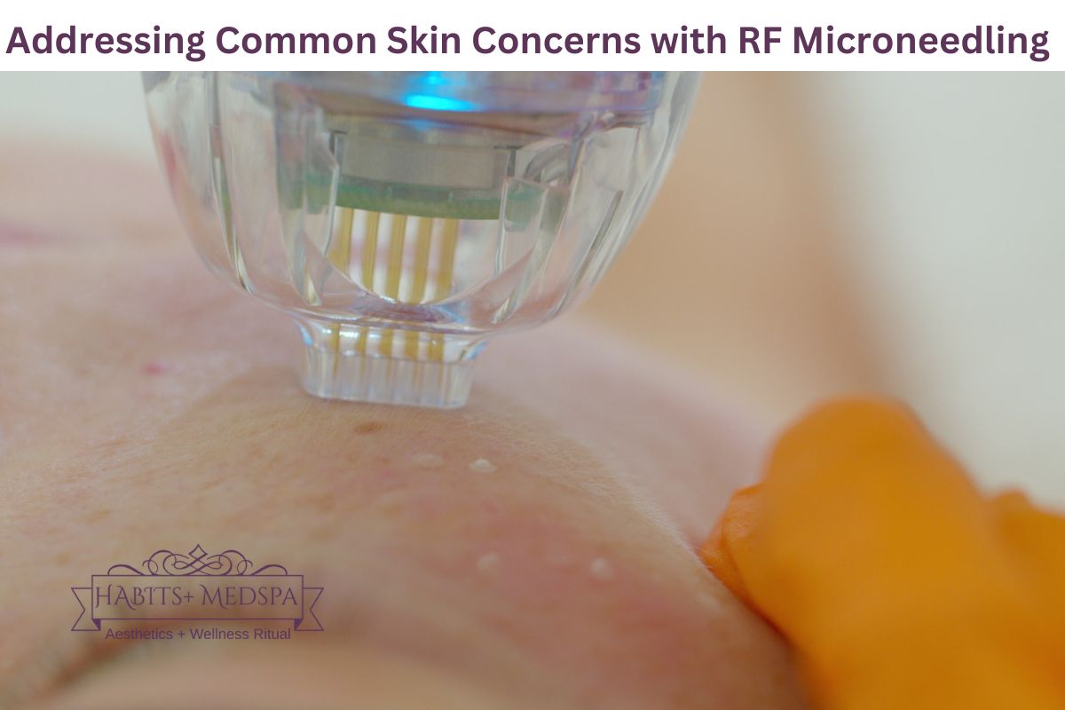 Addressing Common Skin Concerns with RF Microneedling